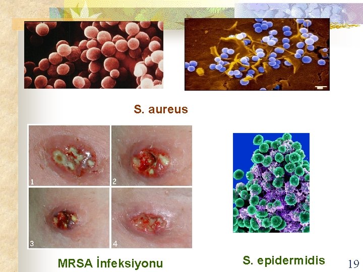 S. aureus MRSA İnfeksiyonu S. epidermidis 19 