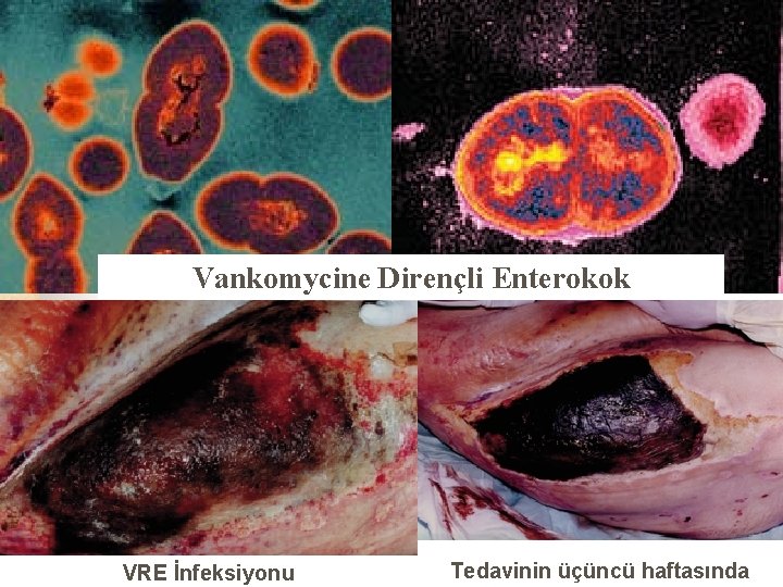 Vankomycine Dirençli Enterokok VRE İnfeksiyonu Tedavinin üçüncü haftasında 26 