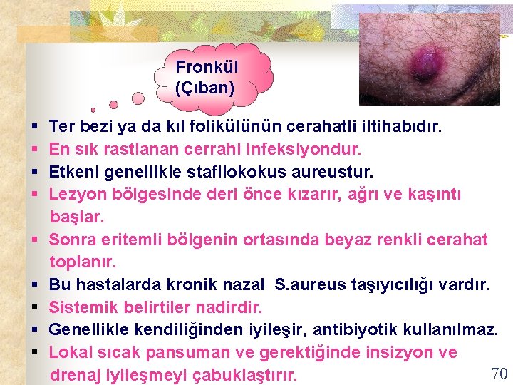 Fronkül (Çıban) § Ter bezi ya da kıl folikülünün cerahatli iltihabıdır. § En sık