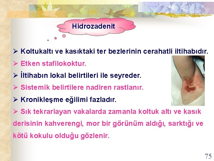  Hidrozadenit Ø Koltukaltı ve kasıktaki ter bezlerinin cerahatli iltihabıdır. Ø Etken stafilokoktur. Ø