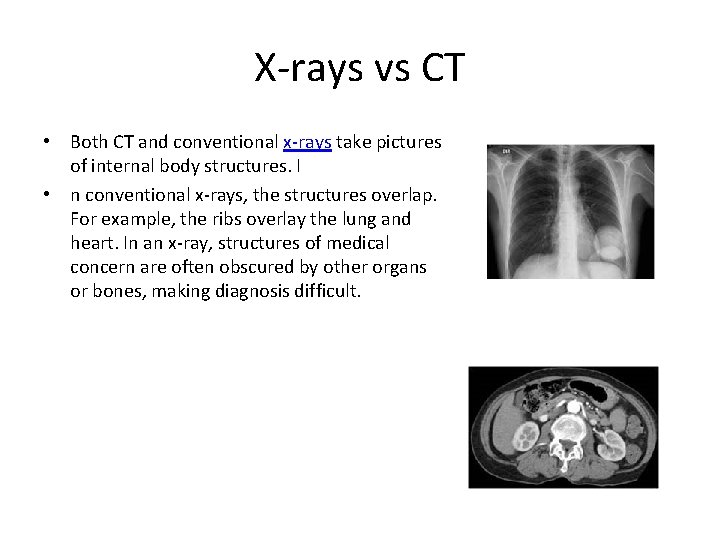 X-rays vs CT • Both CT and conventional x-rays take pictures of internal body