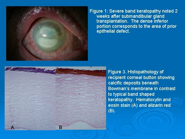 Figure 1: Severe band keratopathy noted 2 weeks after submandibular gland transplantation. The dense