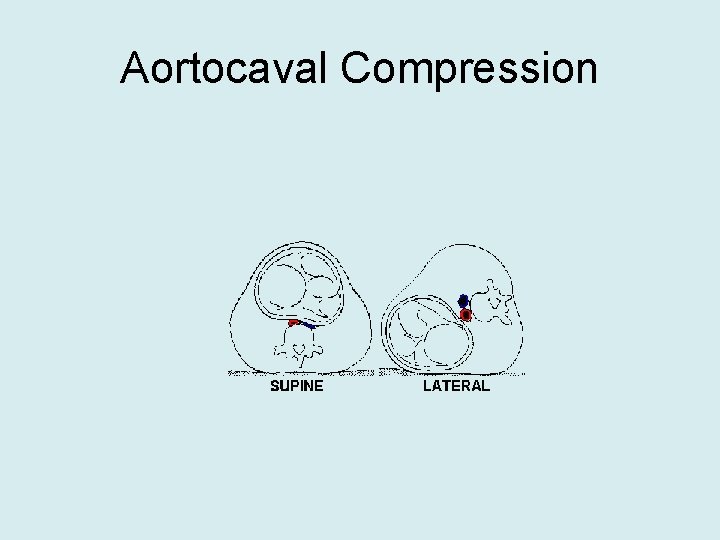 Aortocaval Compression 