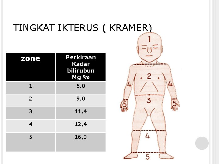 TINGKAT IKTERUS ( KRAMER) zone Perkiraan Kadar bilirubun Mg % 1 5. 0 2