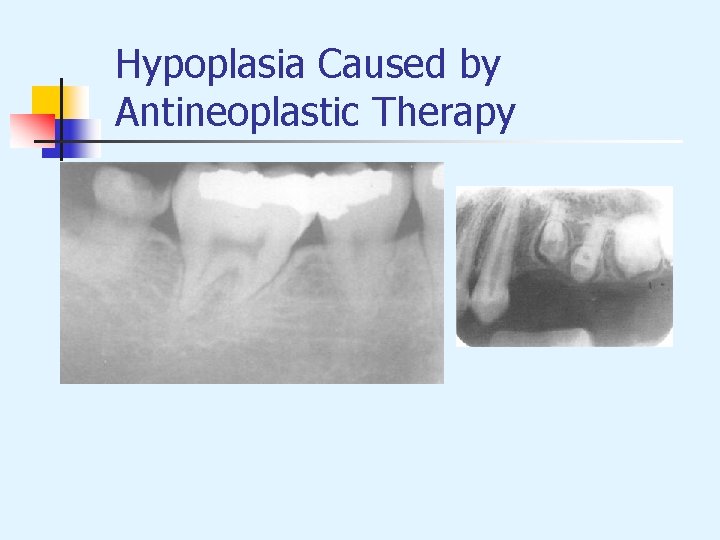 Hypoplasia Caused by Antineoplastic Therapy 