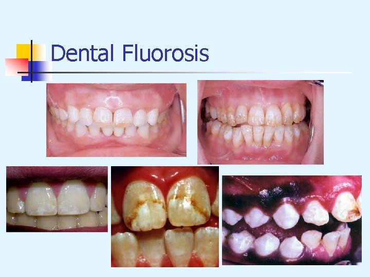 Dental Fluorosis 