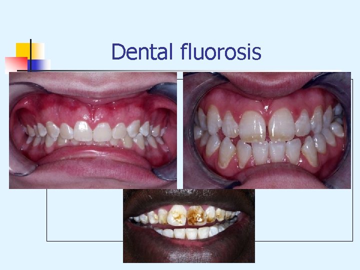 Dental fluorosis 