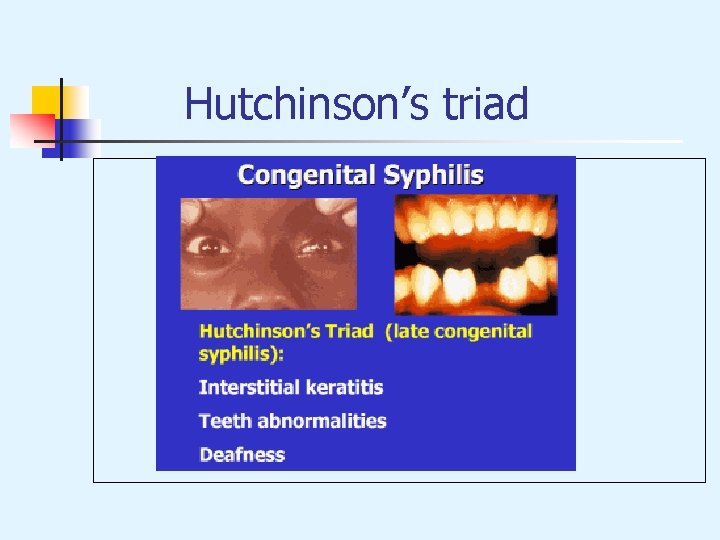 Hutchinson’s triad 