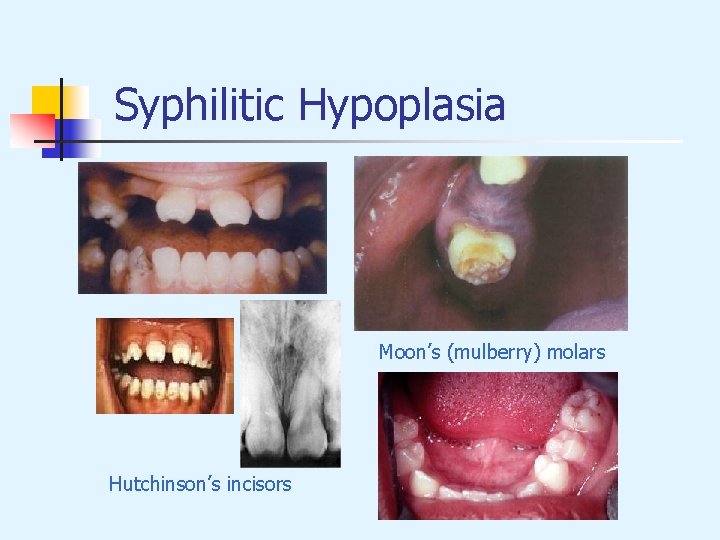 Syphilitic Hypoplasia Moon’s (mulberry) molars Hutchinson’s incisors 