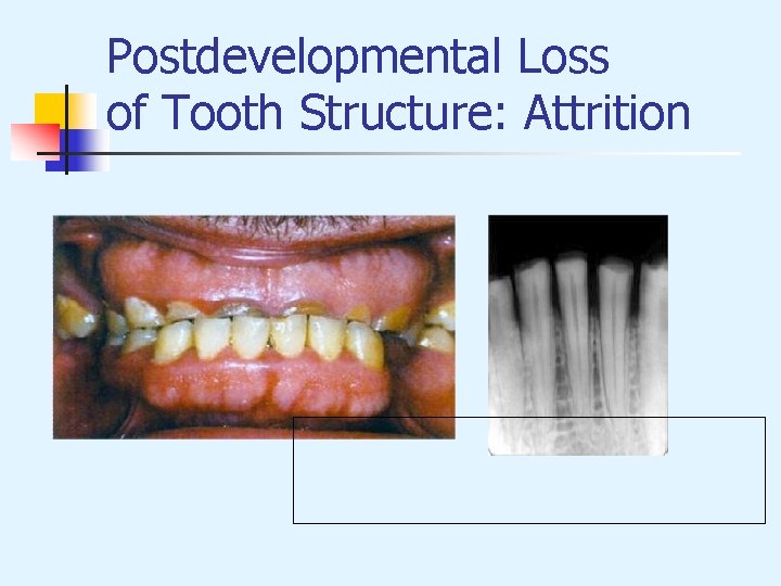 Postdevelopmental Loss of Tooth Structure: Attrition 