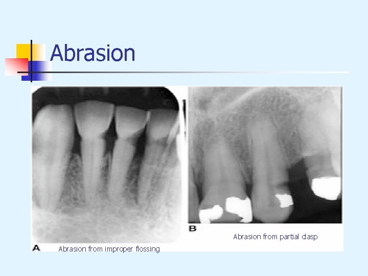 Abrasion from partial clasp Abrasion from improper flossing 