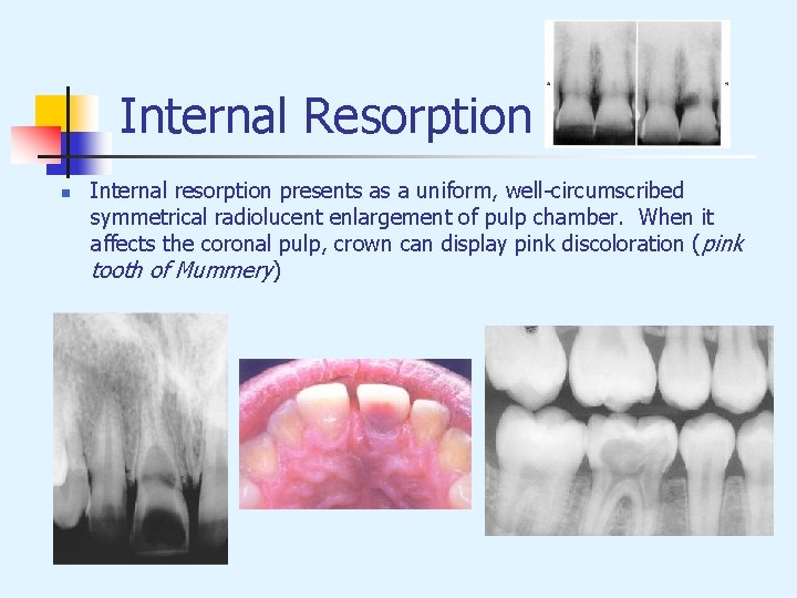 Internal Resorption n Internal resorption presents as a uniform, well-circumscribed symmetrical radiolucent enlargement of