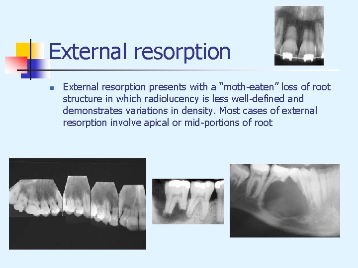 External resorption n External resorption presents with a “moth-eaten” loss of root structure in