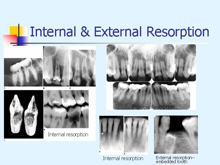 Internal & External Resorption Internal resorption → → Internal resorption External resorption-embedded tooth 