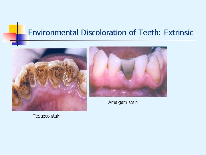 Environmental Discoloration of Teeth: Extrinsic Amalgam stain Tobacco stain 