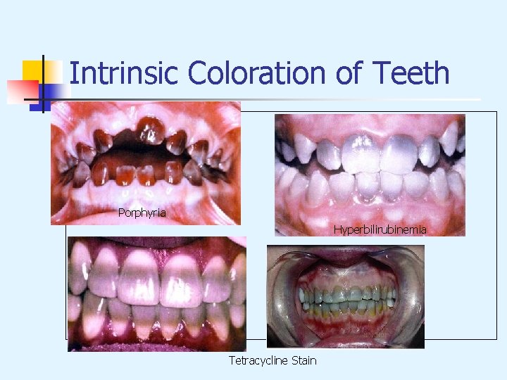 Intrinsic Coloration of Teeth Porphyria Hyperbilirubinemia Tetracycline Stain 