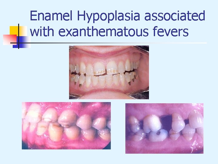 Enamel Hypoplasia associated with exanthematous fevers 