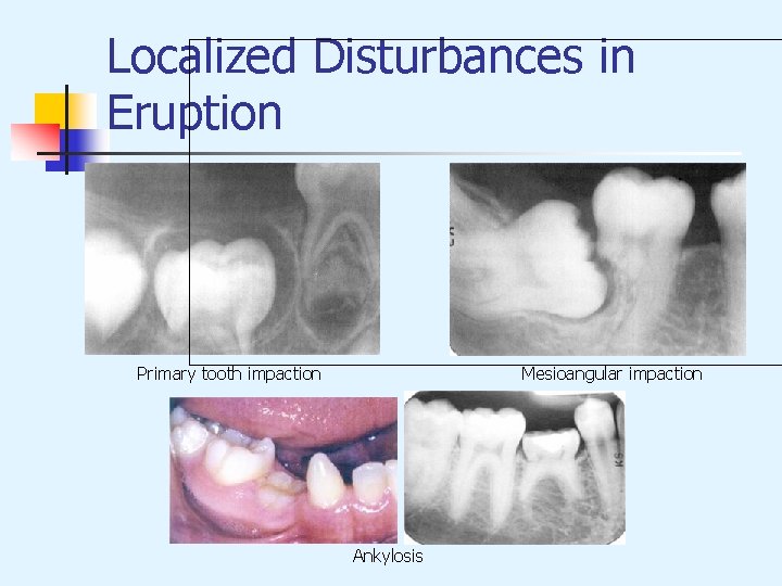 Localized Disturbances in Eruption Primary tooth impaction Mesioangular impaction Ankylosis 