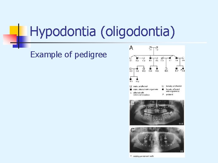 Hypodontia (oligodontia) Example of pedigree 