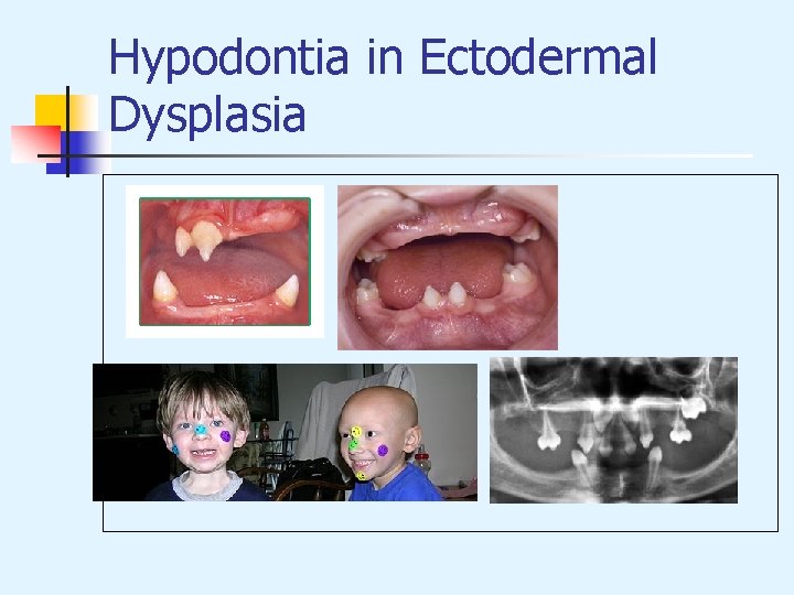Hypodontia in Ectodermal Dysplasia 