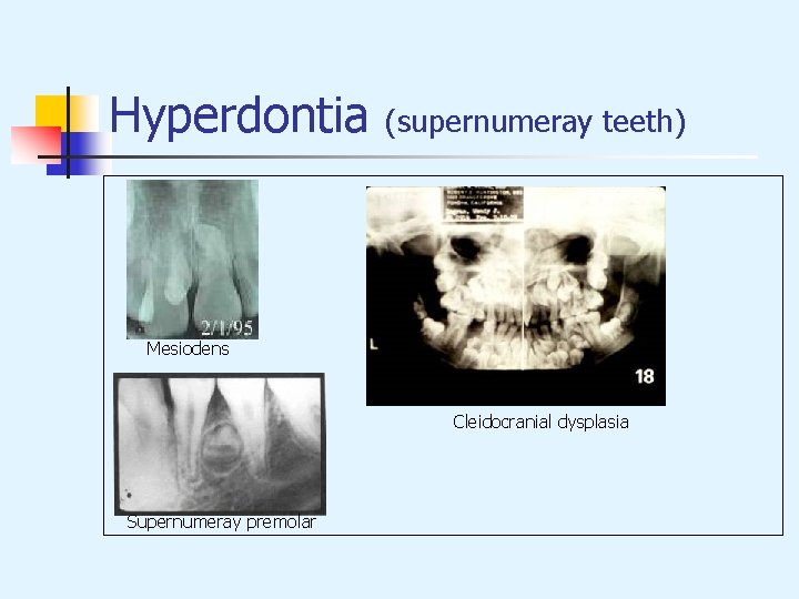 Hyperdontia (supernumeray teeth) Mesiodens Cleidocranial dysplasia Supernumeray premolar 