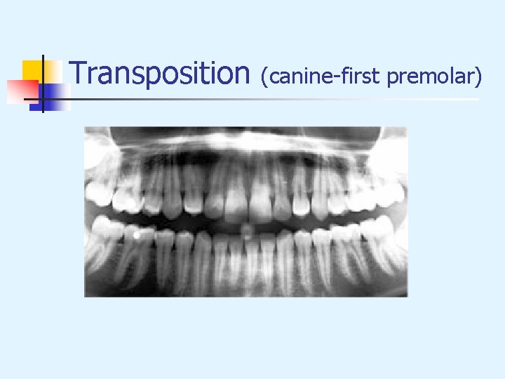Transposition (canine-first premolar) 