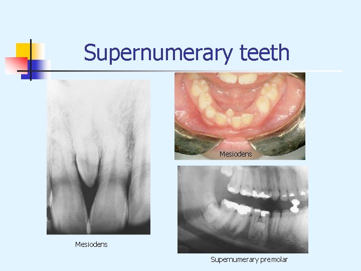 Supernumerary teeth Mesiodens Supernumerary premolar 