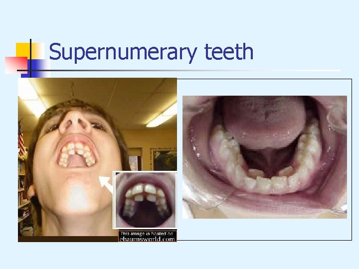 Supernumerary teeth 