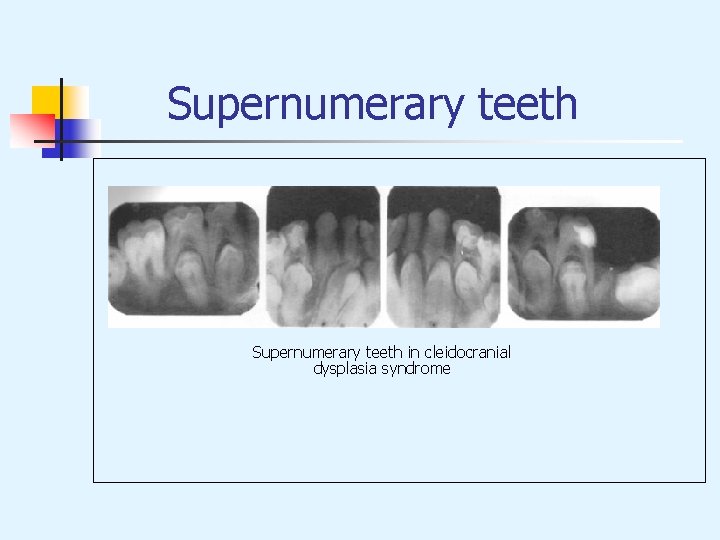  Supernumerary teeth in cleidocranial dysplasia syndrome 