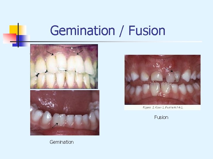 Gemination / Fusion → → Fusion → Gemination 