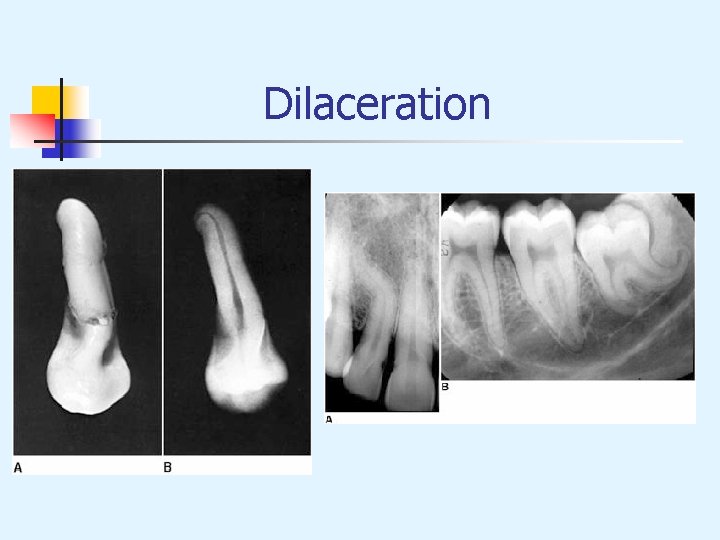  Dilaceration 