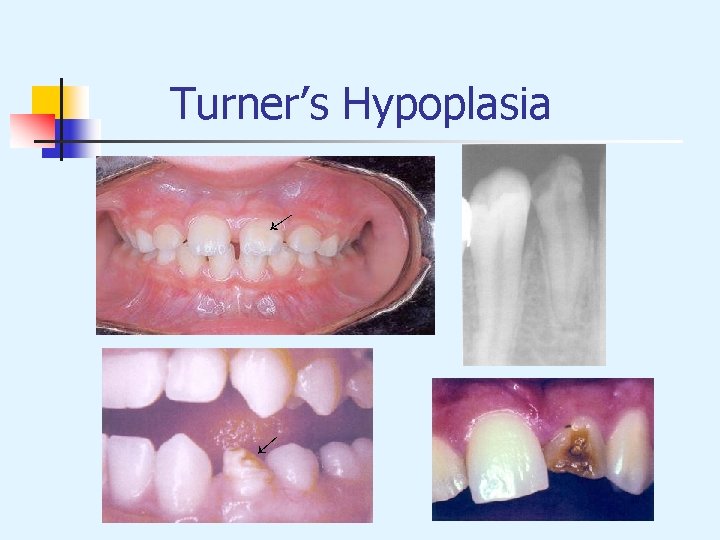 Turner’s Hypoplasia → → 