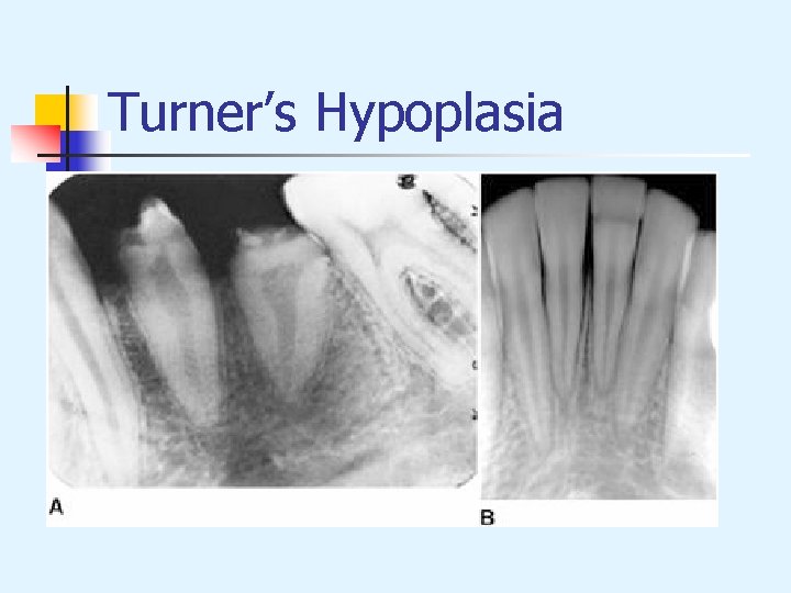 Turner’s Hypoplasia 