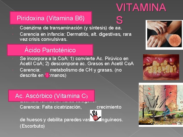  VITAMINA Piridoxina (Vitamina B 6) S Coenzima de transaminación (y síntesis) de aa.