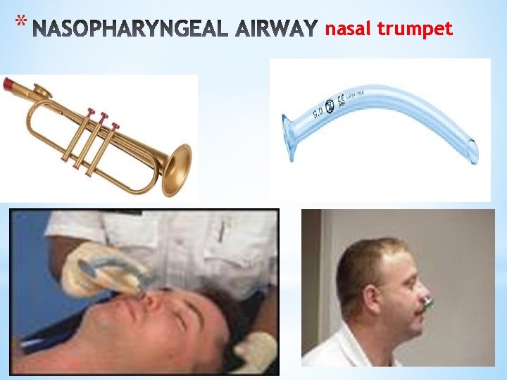 * nasal trumpet 