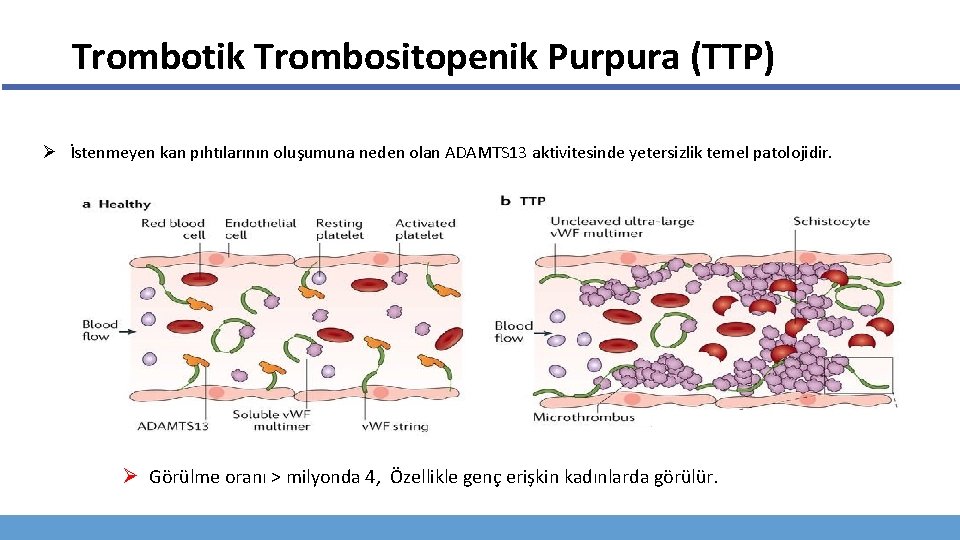 Trombotik Trombositopenik Purpura (TTP) Ø İstenmeyen kan pıhtılarının oluşumuna neden olan ADAMTS 13 aktivitesinde