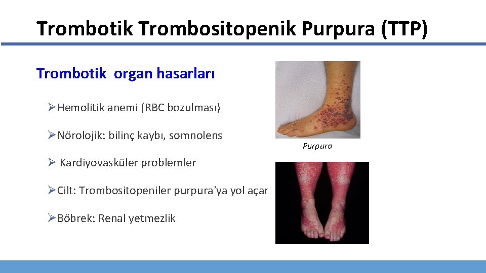 Trombotik Trombositopenik Purpura (TTP) Trombotik organ hasarları ØHemolitik anemi (RBC bozulması) ØNörolojik: bilinç kaybı,