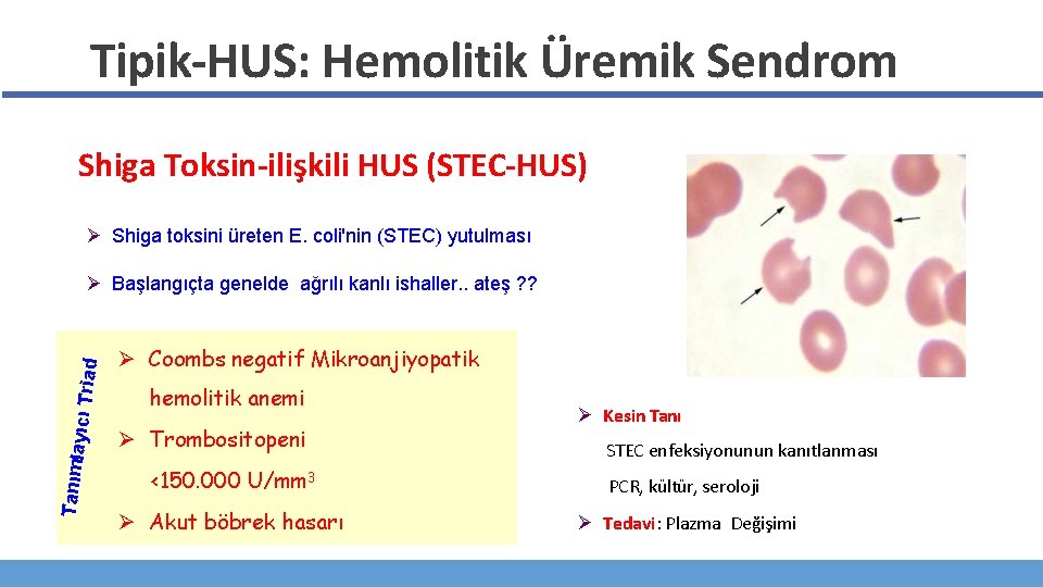 Tipik-HUS: Hemolitik Üremik Sendrom Shiga Toksin-ilişkili HUS (STEC-HUS) Ø Shiga toksini üreten E. coli'nin