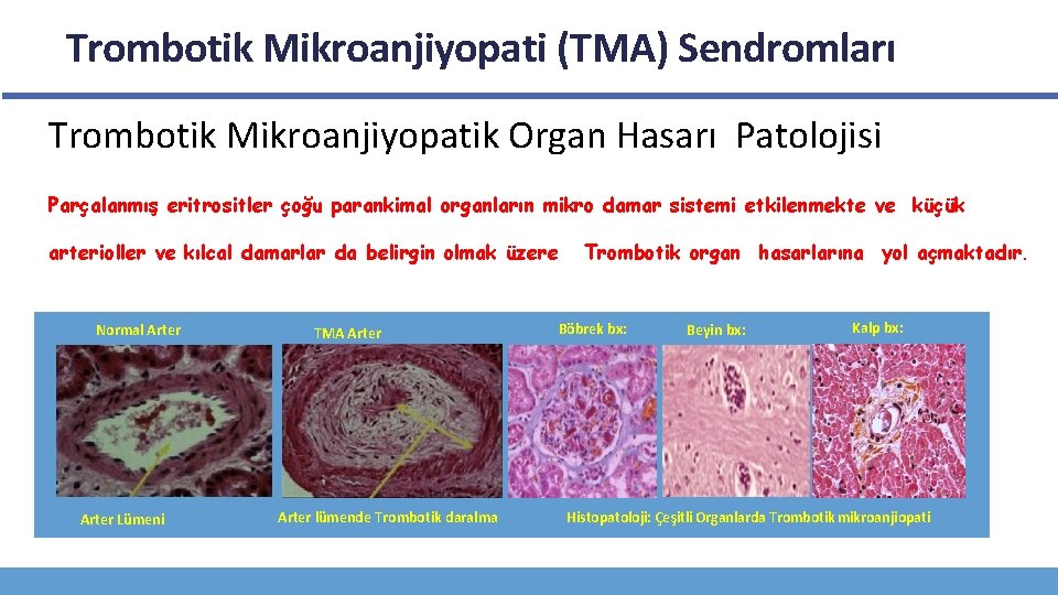 Trombotik Mikroanjiyopati (TMA) Sendromları Trombotik Mikroanjiyopatik Organ Hasarı Patolojisi Parçalanmış eritrositler çoğu parankimal organların