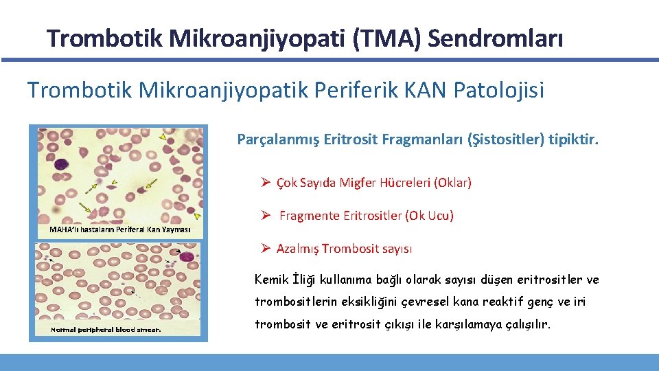 Trombotik Mikroanjiyopati (TMA) Sendromları Trombotik Mikroanjiyopatik Periferik KAN Patolojisi Parçalanmış Eritrosit Fragmanları (Şistositler) tipiktir.