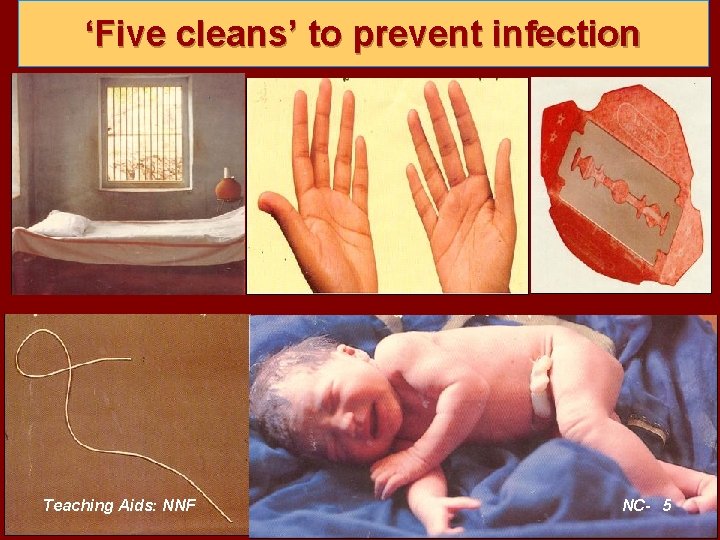 ‘Five cleans’ to prevent infection Teaching Aids: NNF NC- 5 