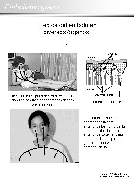 Embolismo graso. Efectos del émbolo en diversos órganos. Piel. Émbolos. Epidermis. Dirección que siguen