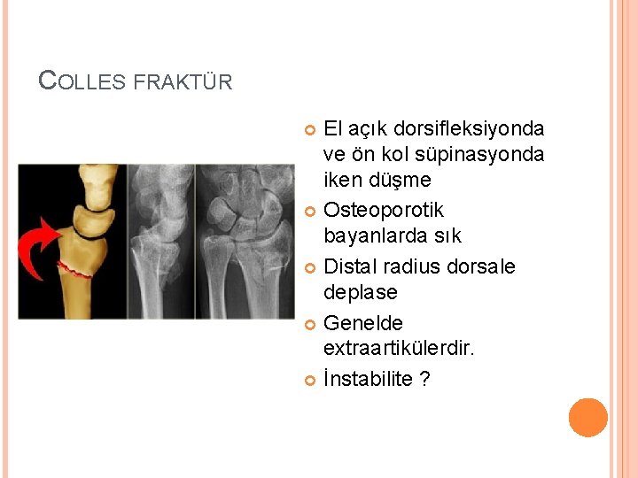 COLLES FRAKTÜR El açık dorsifleksiyonda ve ön kol süpinasyonda iken düşme Osteoporotik bayanlarda sık