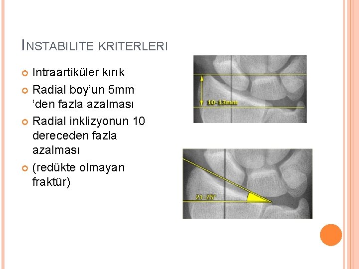 INSTABILITE KRITERLERI Intraartiküler kırık Radial boy’un 5 mm ‘den fazla azalması Radial inklizyonun 10
