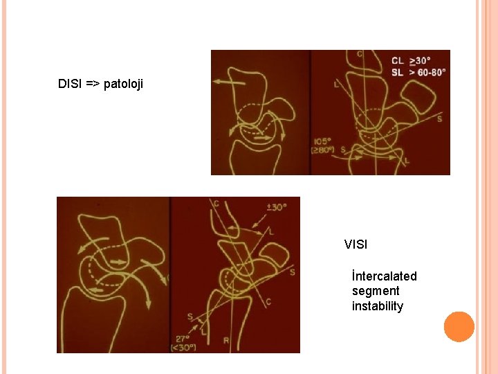 DISI => patoloji VISI İntercalated segment instability 