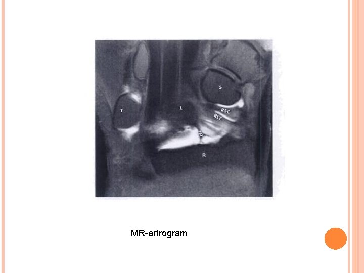 MR-artrogram 