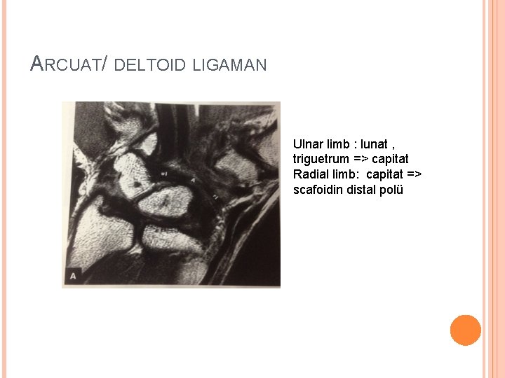 ARCUAT/ DELTOID LIGAMAN Ulnar limb : lunat , triguetrum => capitat Radial limb: capitat