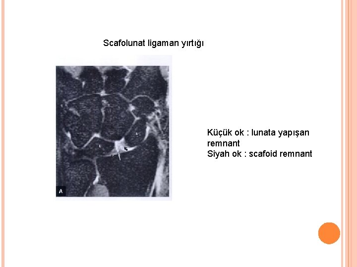 Scafolunat ligaman yırtığı Küçük ok : lunata yapışan remnant Siyah ok : scafoid remnant