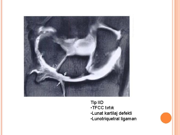 Tip IID • TFCC tırtık • Lunat kartilaj defekti • Lunotriquetral ligaman 