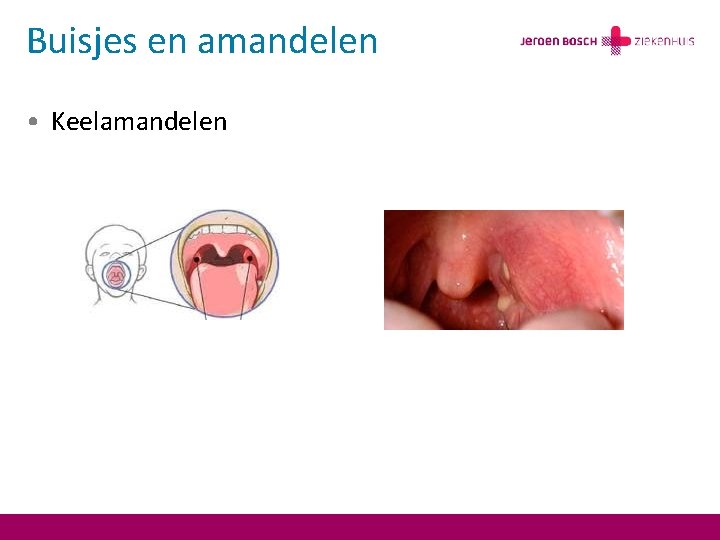 Buisjes en amandelen • Keelamandelen 